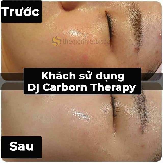 Mặt nạ CO2 DJ Carbon Therapy