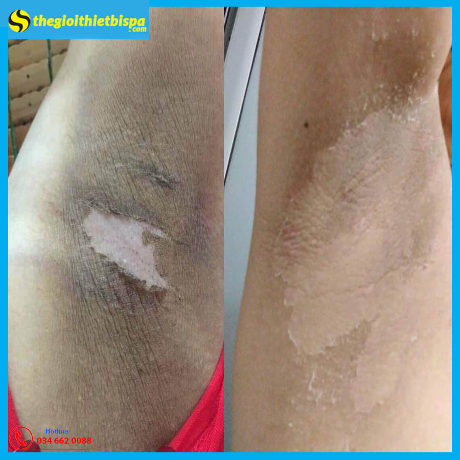 Peel pink TCA làm hồng nhũ hoa, trị thâm Peel pink TCA làm hồng nhũ hoa, trị thâm