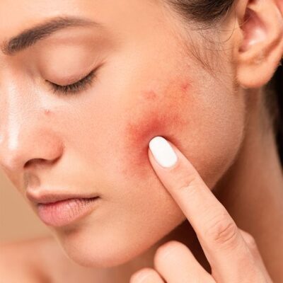 Lời Khuyên Dành Cho Những Người Bị Mụn